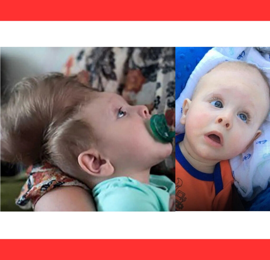 The Miracle of Bentley Yoder: Baby Born With His Brain Outside His Skull – And He Survived